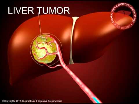 weight-reduction plan for liver cancer remedy breast most cancers studies on remedy