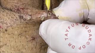 Kondilom ( Genital Siğil ) Koterizasyonu/OP.DR.TAYFUN BUDAK