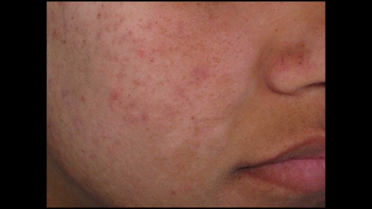 oxy pimples remedy