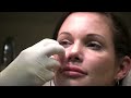 Liquid Midface Lift (Cheek Augmentation with Perlane) by Chevy Chase Maryland cosmetic surgeon