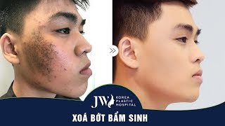Trở thành HOT BOY sau khi xóa VẾT BỚT bẩm sinh trên mặt