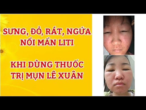 mặt sưng đỏ và ngứa mẩn li ti rát nóng tróc vẩy khi dùng thuốc đông y Lê Xuân | 0979195628