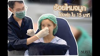 ร้อยไหมจมูก เทคนิคดีดปลาย เพิ่มสัน บิดได้อย่างเป็นธรรมชาติ ยกให้โด่งพุ่ง ใน 15 นาที (EP1)