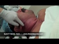 Neck abscess incision and drainage video - Dr. Sunil P. Verma MD