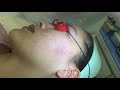 XỬ LÝ MỤN ẨN BẰNG CÔNG NGHỆ LASER VI ĐIỂM TẠI DR SKIN