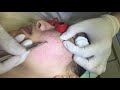 XỬ LÝ MỤN ẨN BẰNG CÔNG NGHỆ LASER VI ĐIỂM TẠI DR SKIN