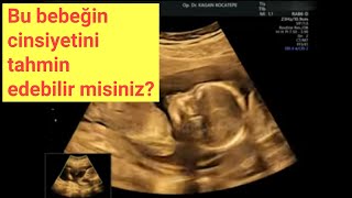 16 haftalık gebelik. Kız mı, erkek mi? Bu ultrason görüntülerinden cinsiyeti görmek mümkün mü?