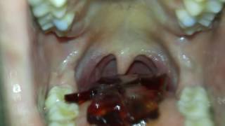 Gummyman Vore
