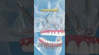 Zygomatic Dental Implants The 3D Revolution