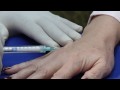 The Radiesse Hand Lift Age Reducing Treatment - Hand Rejuvenation, Cosmetic Fillers