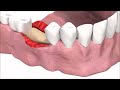 Dental Implantology - Standard Surgery Animation: SICmax implant insertion