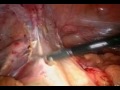 Colon Surgery