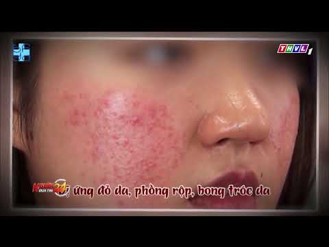 SỬ DỤNG HUYẾT THANH TRẮNG DA - HIỂM HỌA KHÔN LƯỜNG | UMC | Bệnh viện Đại học Y Dược TPHCM