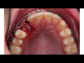 Impacted Canine patient talking about his experience - Dr. Lana Dalbah