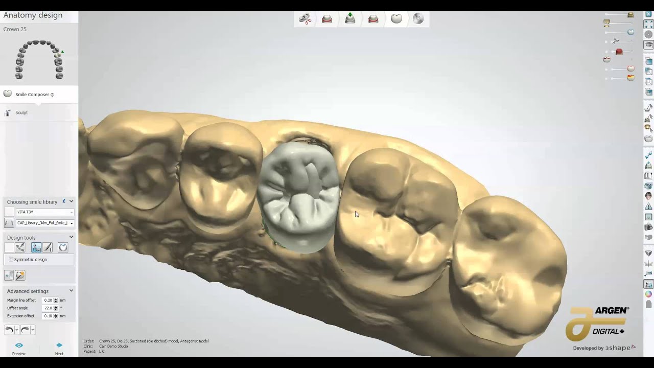 First case with 2014 3Shape Dental System - YouTube