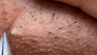 Ingrown Hair Removal - Longest Plucking Video Yet Dermaplaningeyebrow Shaving