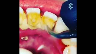 Limpieza Dental De Sarro Con Ultrasonido Piezoelectrico