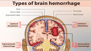 Ct Scan Brain M Blood Kesa Dikta H