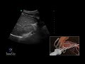 3D How To: Right Kidney Ultrasound - SonoSite Ultrasound