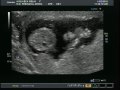 13w1d ultrasound NT scan gender peak