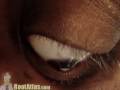 Keratoconus - Prevalence - Article Index Keratoconus - Prevalence - Article Index