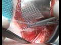 hernioplastia