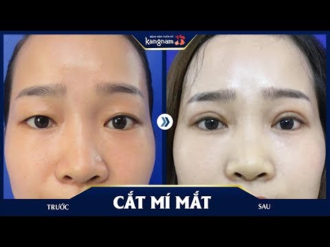 Ở Hà Nội - Cắt mí mắt ở đâu đẹp nhất
