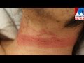 Postmortem Findings in Cases of Hanging and Ligature Strangulation | Manorama News Postmortem Findings in Cases of Hanging and Ligature Strangulation | Manorama News