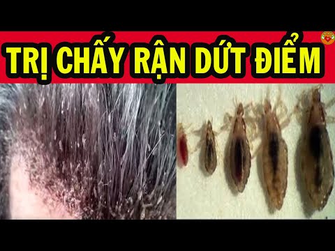 11 Cách Trị Chấy Rận Tại Nhà Cực Đơn Giản, Hiệu Quả | SKSĐ