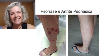 Terezinha - Psoríase e Artrite Psoriásica