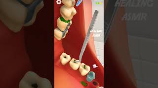Asmr Cleaning The Teeth Dental Cleaning