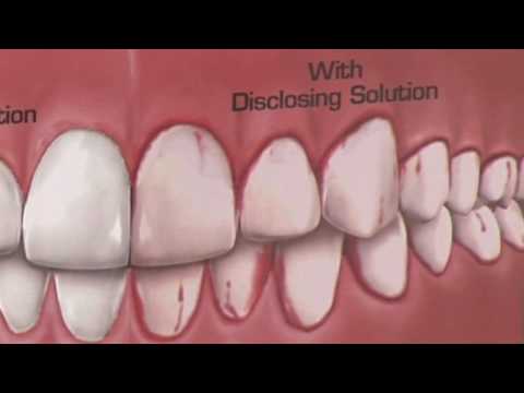 Dental Health Gum Disease : How Is Plaque Detected?