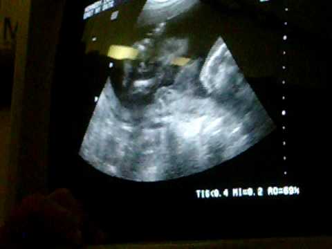 ultrasound 8 weeks. Ultrasound 8 Weeks 2 Days