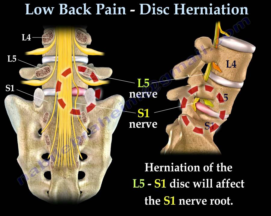 Low Back Pain - Disc Herniation  Sciatica