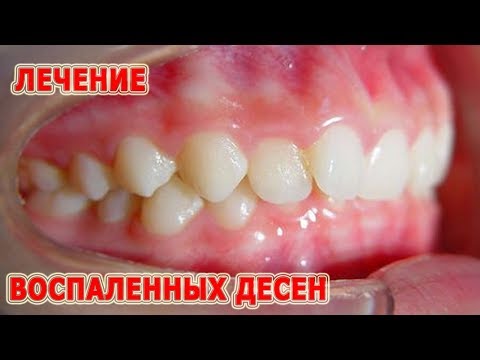 Чем полоскать если болят дёсна в домашних условиях 194 Чем полоскать если болят дёсна в домашних условиях 118