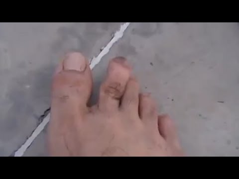 Dislocated Toe, Popped Back In - MAJER Jacob