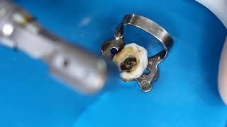 Blindagem Da Câmara Pulpar De Dente Decíduo Com Pbs Cimmo Hd