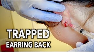 Removing A Trapped Earring Back From Inside The Earlobe Dr Paul Removing A Trapped Earring Back From Inside The Earlobe Dr Paul