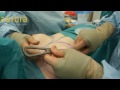 Double PIP Implant Rupture - Removed and Replaced through the Areola