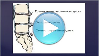 Как лечить секвестрированную грыжу диска l5-s1 Как лечить секвестрированную грыжу диска l5-s1
