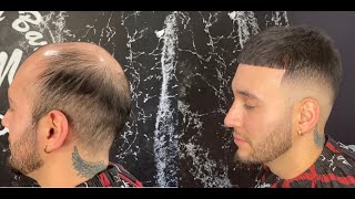 From Bald to  Head of Hair by @mickeydabarber I Hair Unit