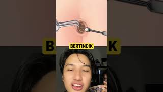 Bertindik Perutnya
