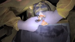 Cheng Crowns In The Or With Dr. Jason M. Bresler D.m.d.