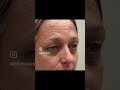 Blepharoplasty Surgery   Eyelid Surgery   Fat Grafting to the face