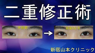 眠そうな目をはっきりさせる!!他院全切開重瞼術後の修正。修正のご相談は、新宿 山本クリニックへ☆