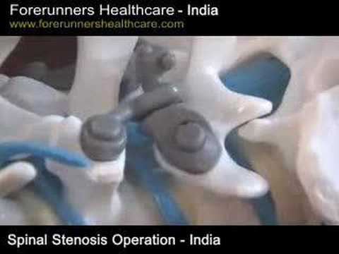surgery for cervical stenosis