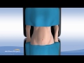 Single Incision Gallbladder Surgery - Cholecystectomy - Pittsburgh