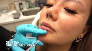 Chin Botox For Dimpling Truecare Medspa