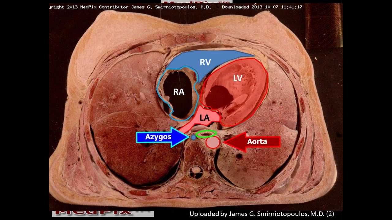 Normal Chest Axial Anatomy - plain and labeled sections - YouTube