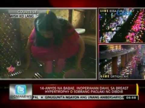 Breast+Hypertrophy+Pictures ... , inoperahan dahil sa breast hypertrophy o sobrang paglaki ng dibdib